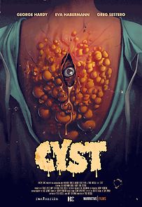 Watch Cyst
